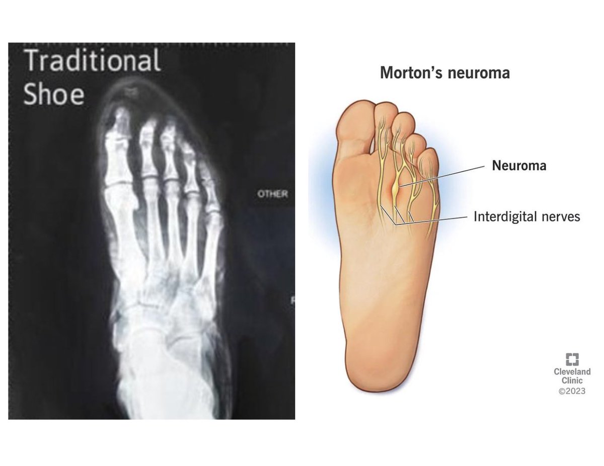 Activ8shoes's tweet photo. 4. Tissue Compression

Narrow shoes can compress the soft tissues of the foot, including the skin, muscles, tendons, and nerves. 

Prolonged compression can even lead to issues like nerve impingement or irritation, such as Morton’s neuroma. https://t.co/bNRXm1Y0Fd