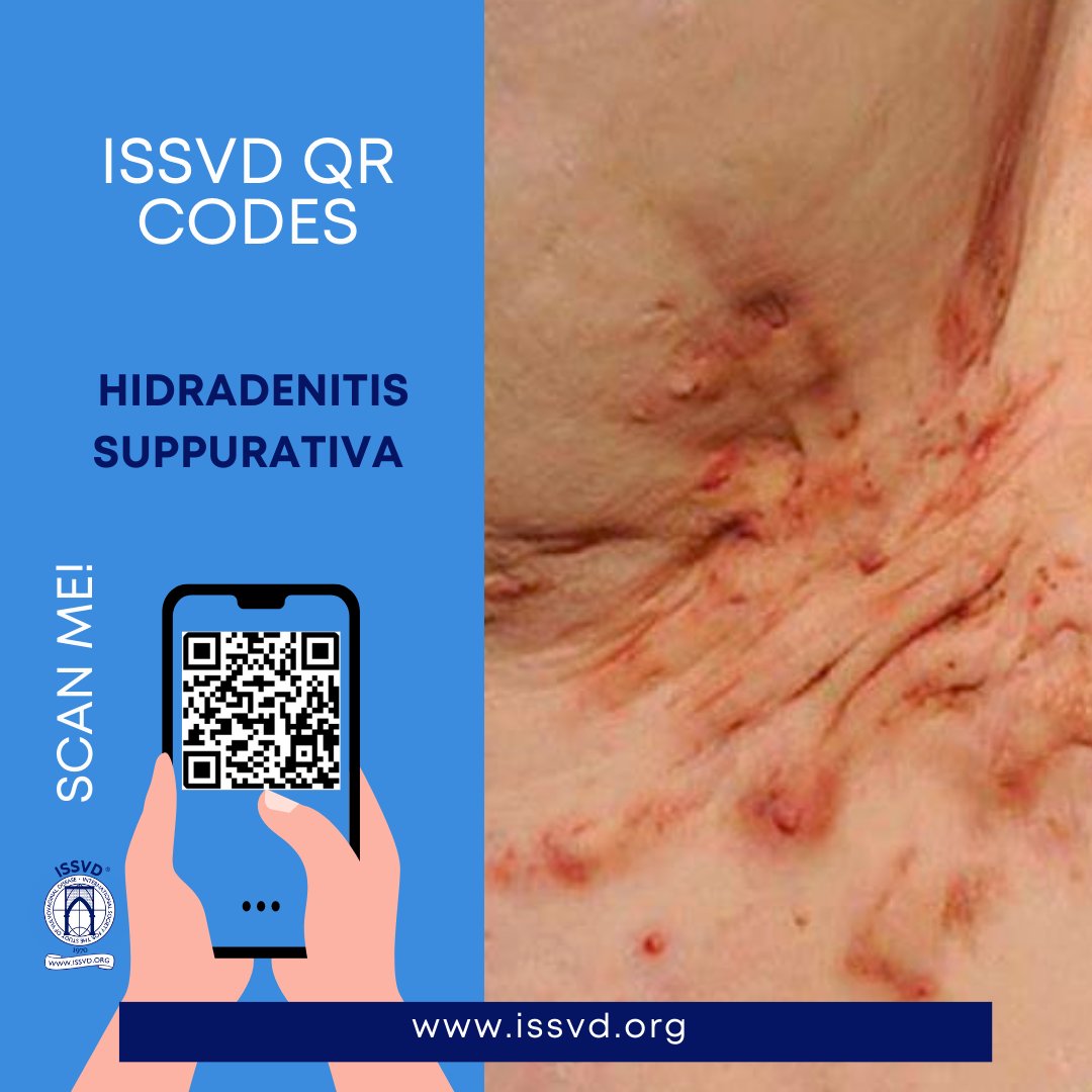 Hidradenitis suppurativa affects up to 4% of people. It is more common in women than in men. It can cause boils and scarring on the vulva and groin and often goes undiagnosed for many years.
By scanning the QR code you will be able to obtain more information about this pathology.