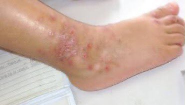 moodtimeline's tweet photo. Treatment menghilangkan bekas luka

- A Thread — https://t.co/IiiptGquvB