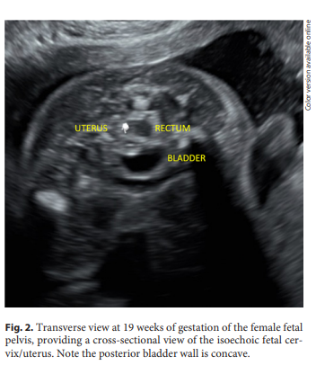 WCHKarger's tweet photo. #Sonographic Assessment of #Fetal Sex: More than External Genitalia
🔗 https://t.co/xdHU4hlRsb
✍ Smet M.-E. et al.
📖 #FetalDiagnTher
#FetalSex #Ultrasound https://t.co/HOoZg2ZyOl