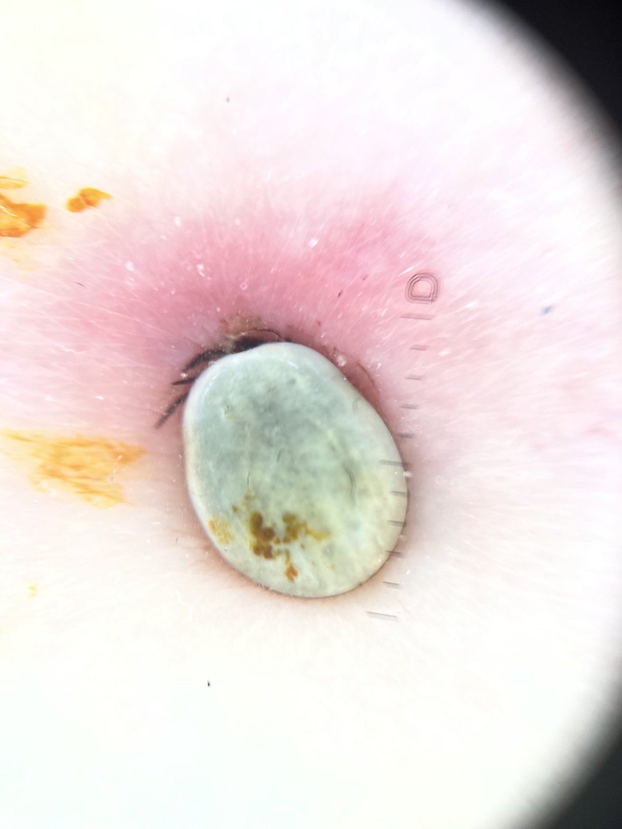 derm_bossy's tweet photo. Patient thinking it was a skin tag. https://t.co/GCDnIsKc82