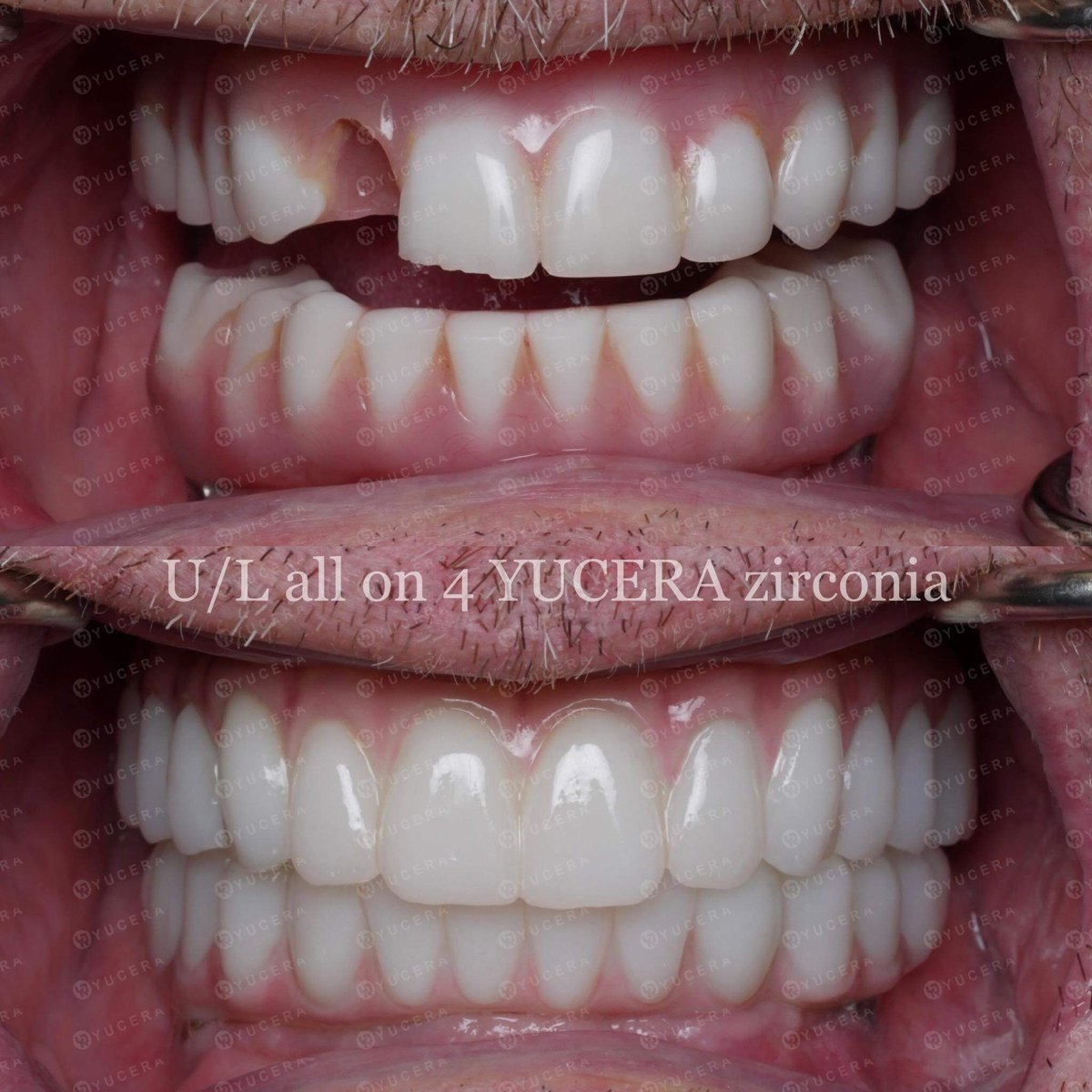 Yuceradental's tweet photo. Master: Goran
Materials: Yucera 4D Pro zirconia blocks
Shade: B1
#Yucera #dental #dent #dentistry #dentallab #dentallaboratory #dentaltechnician #clinic #dentist #zirconia #zirconiablocks #4Dpro #zirconiadiscs #zirconium #zirconiumblocks #Aesthetic
#Restoration #denture #implant https://t.co/VKERFHbhEK