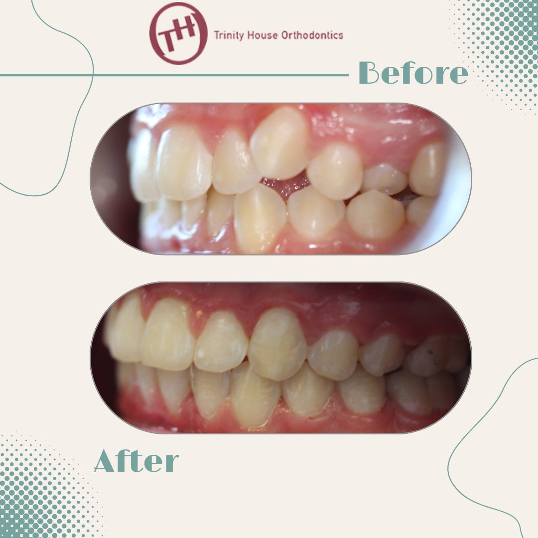 Transformation Tuesday✨ Check out these gorgeous new smiles that the team at Trinity House have achieved😁 #Transformationtuesday #Beforeandafter #Ortho #THOsmile #Trinityhouseorthodontics