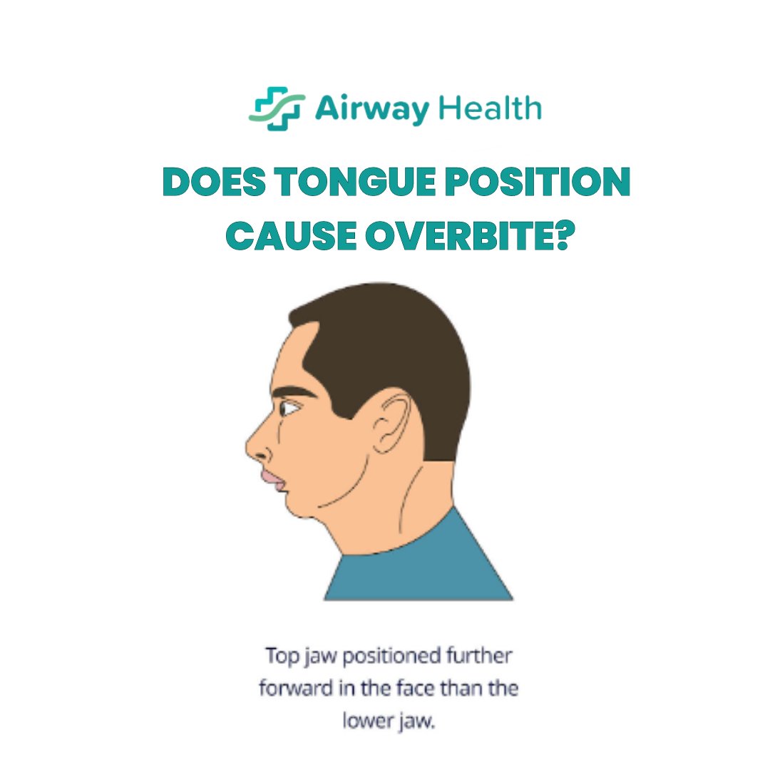 Airway_Health_'s tweet image. Does tongue position cause overbite? Improper tongue posture is not conducive to good facial growth and will often result in either an overbite or an underbite. In the case of an overbite, a low tongue posture causes the jaws and face to grow in a downward fashion  #Overbite