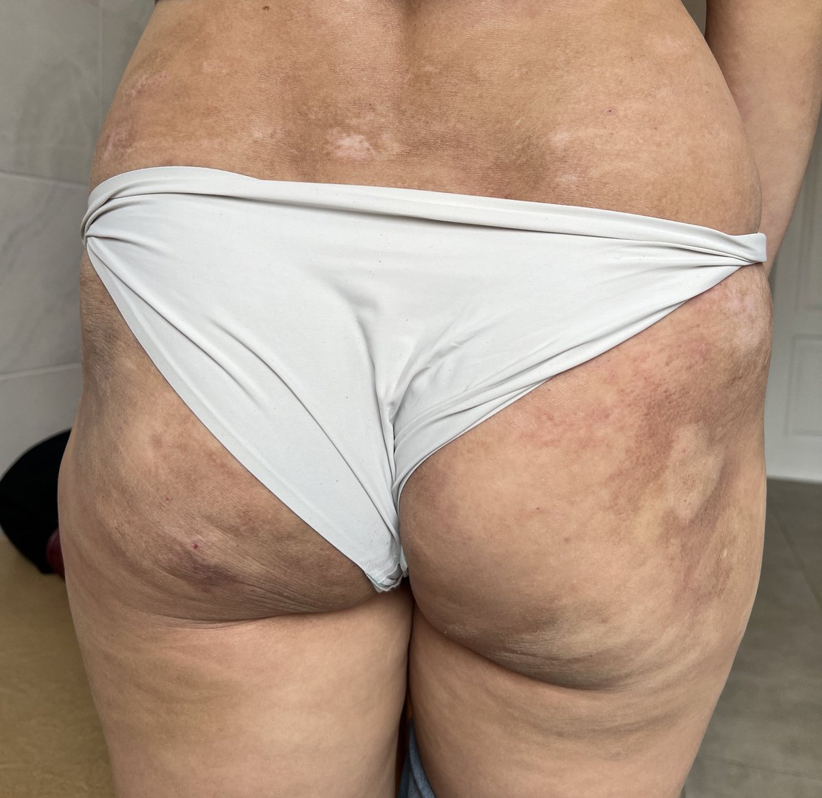 derm_bossy's tweet photo. mycosis fungoides https://t.co/T8KaITLx5D