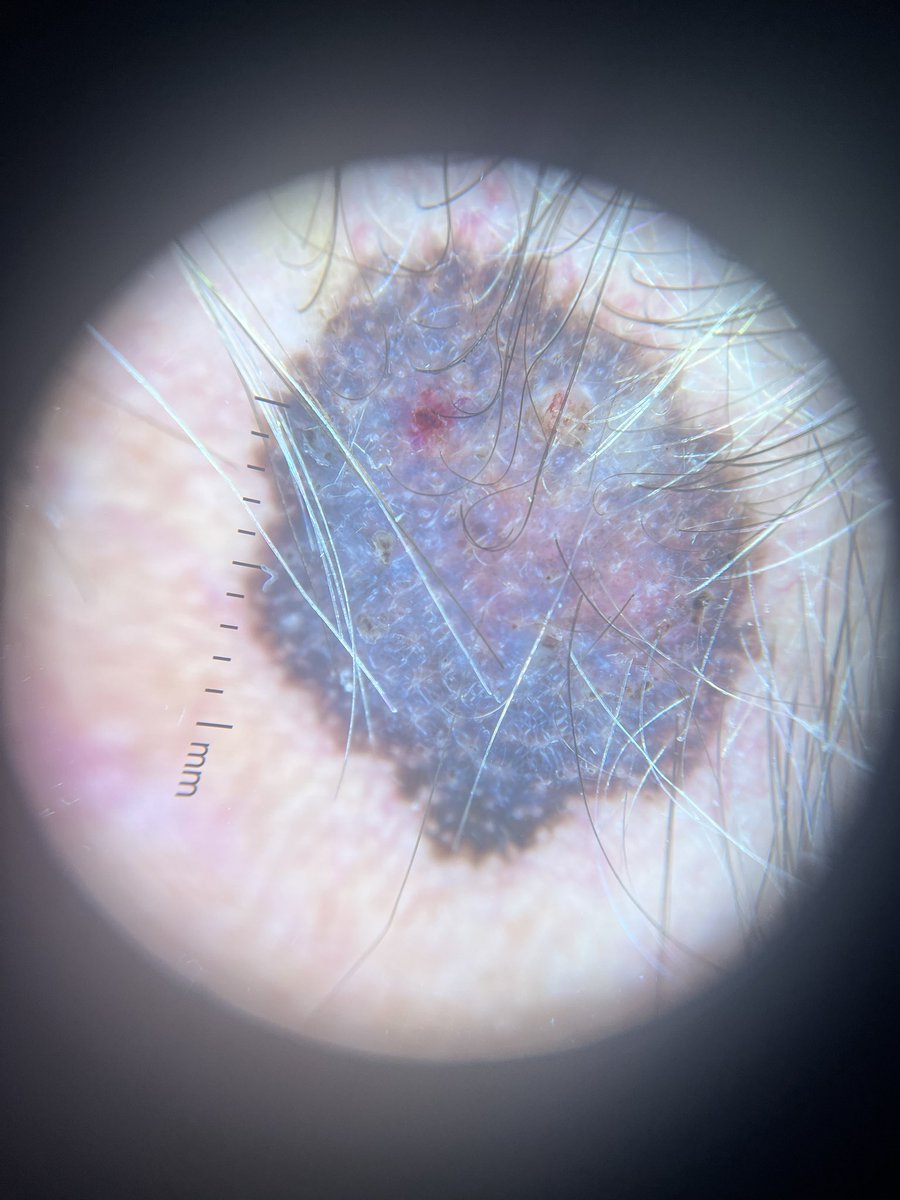 derm_bossy's tweet photo. Another melanoma. https://t.co/QK16vMlaBD