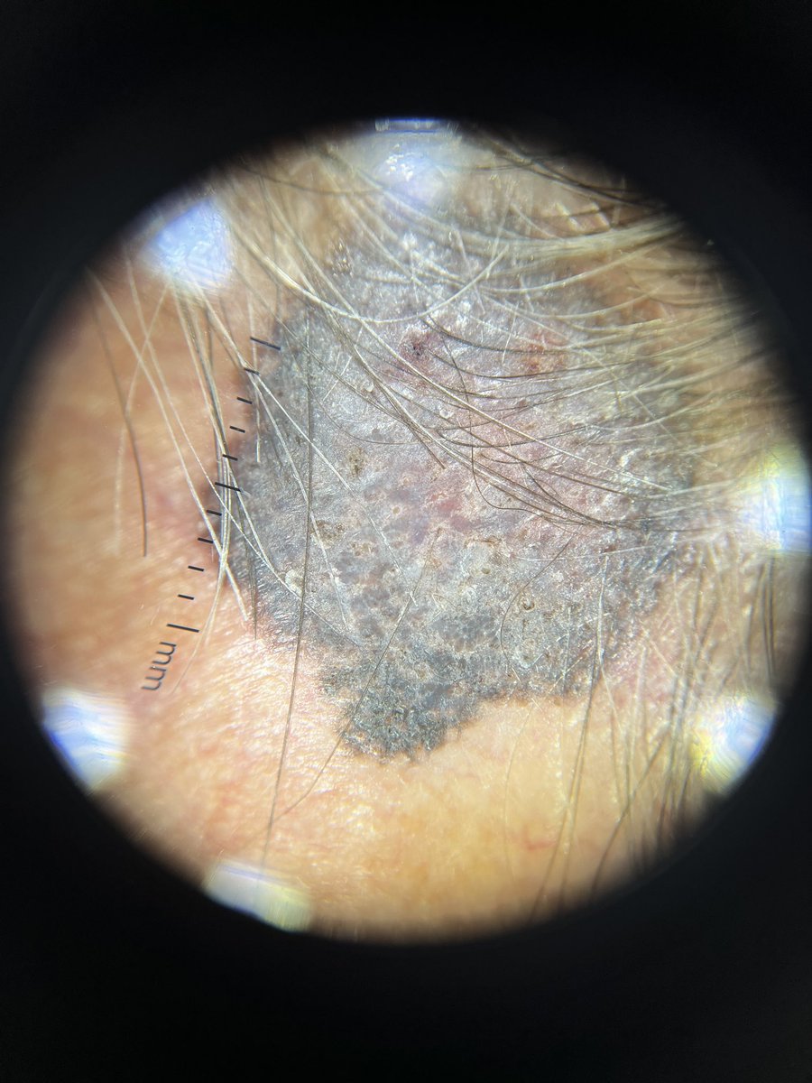 derm_bossy's tweet photo. Another melanoma. https://t.co/QK16vMlaBD