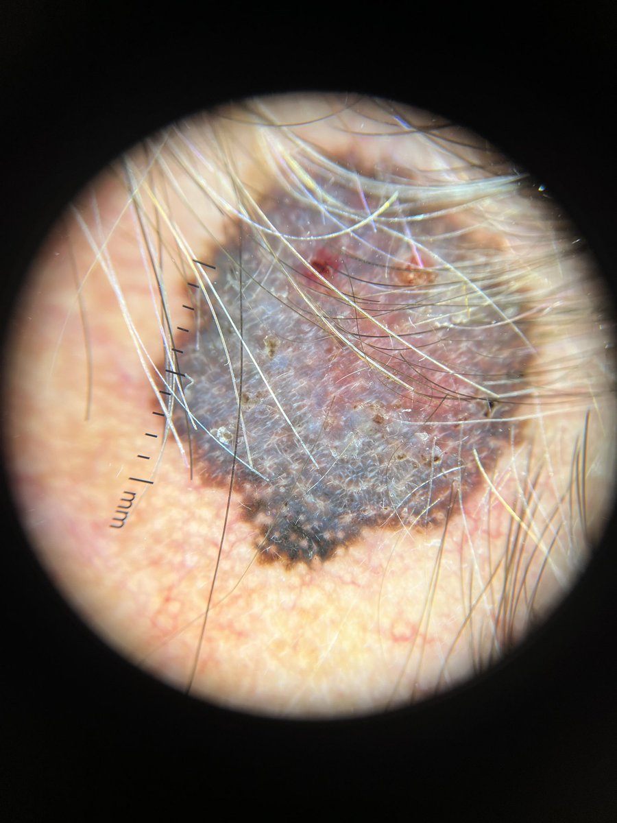 derm_bossy's tweet photo. Another melanoma. https://t.co/QK16vMlaBD