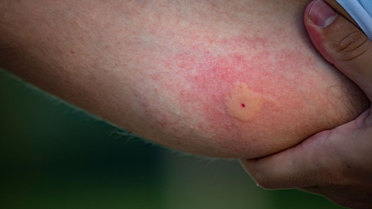 In den allermeisten Fällen handelt es sich bei den starken Schwellungen nach #Mückenstichen um eine Entzündung und nicht um eine #Allergie. ow.ly/3BGc50OYXvY