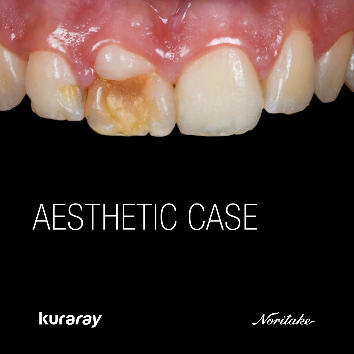 Kuraray_Dental's tweet photo. Have you already read the Spring LabLine magazine? It has a wonderful AESTHETIC CASE by Mikel Villar Gonzales and Pilar Ballesteros Galan. Check it out! 
#kuraraynoritake #borninjapan #dentistry #labtechnician #labline #aestheticcase #aesthetics https://t.co/7Mqq8otU7h https://t.co/cCFzcJs5eX