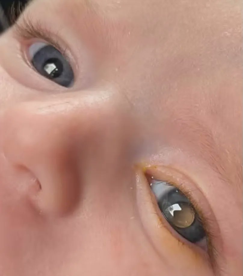 Amber and Jack shared Robyn's retinoblastoma story recently on ITV. Thank you for helping to create awareness of retinoblastoma! 
 
You can watch their interview here: buff.ly/43eRzEv