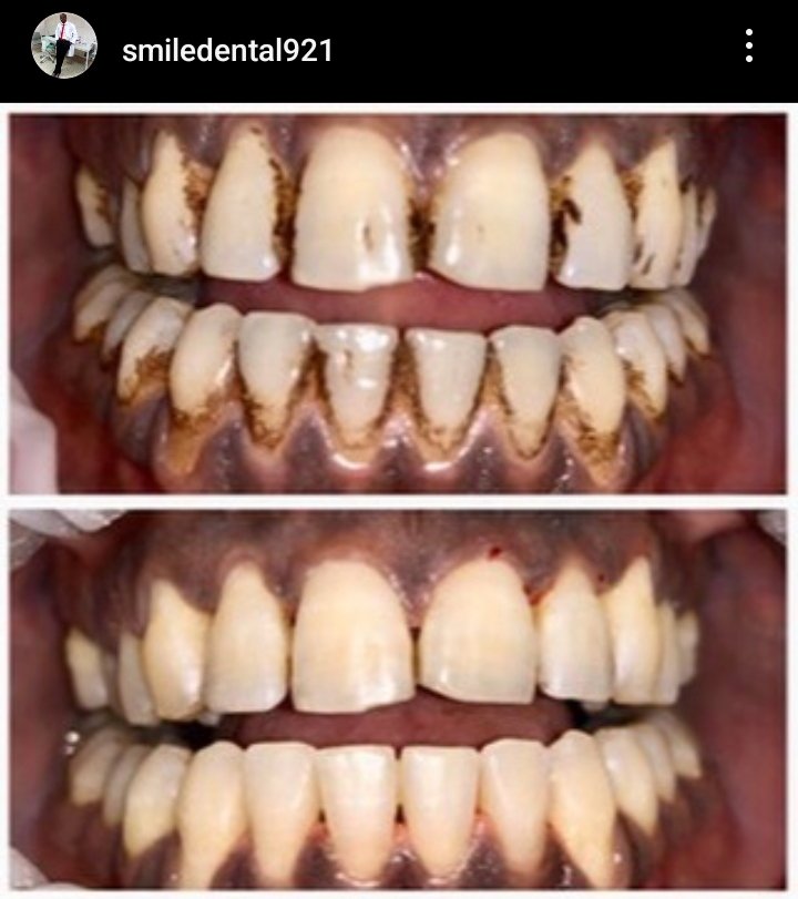 GrantJosephen's tweet photo. Appointment open for all dental treatment
099807305 (34 military hospital Wilberforce) https://t.co/16uF9GFRCe