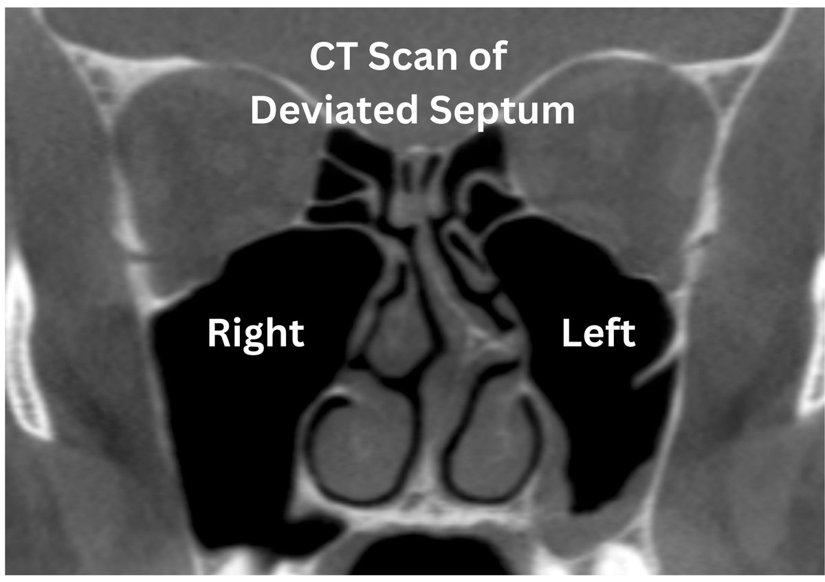 jimatkinsmd's tweet photo. Just published my 4th Newsletter. Today's topic explains septal deviations and whether you need to fix them. https://t.co/Ztx9BLQMdL
#nasalcongestion #septaldeviation https://t.co/QglzK0DNKJ