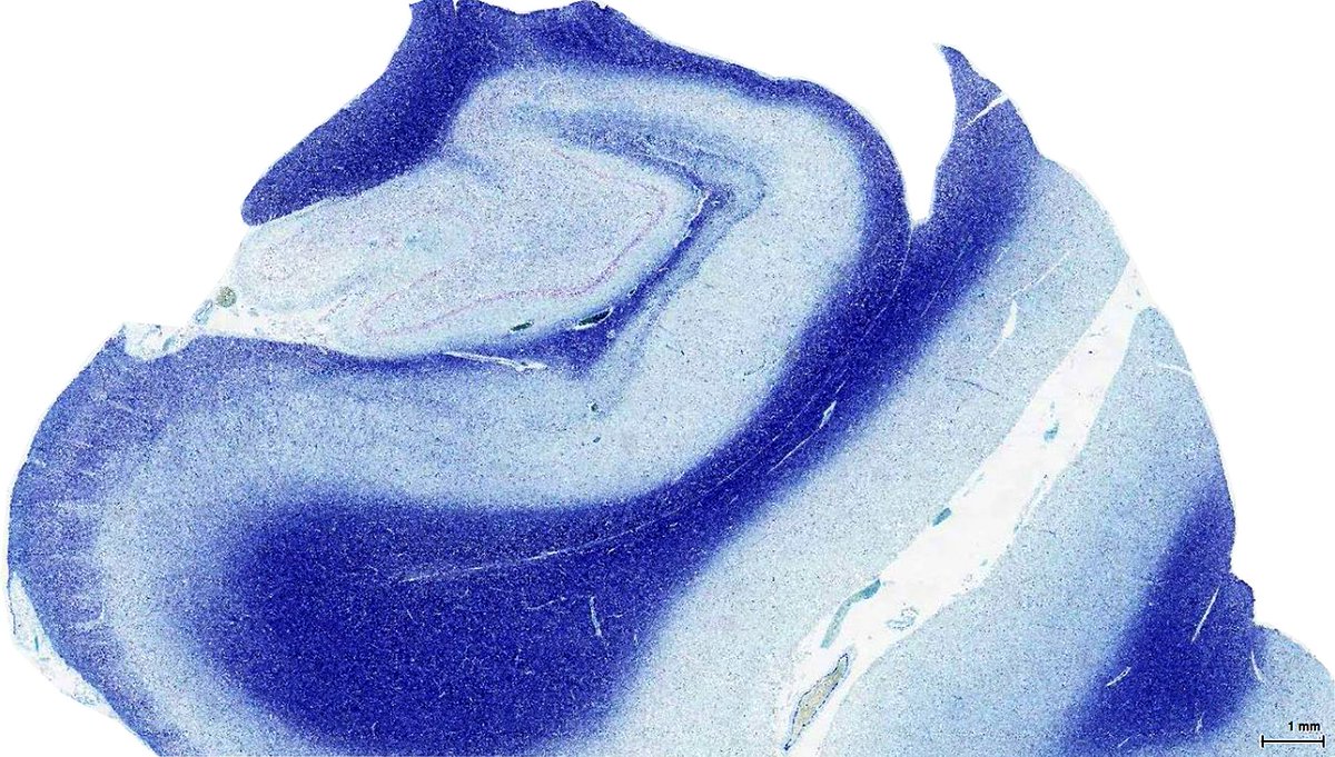 By studying brain tissue samples we have been able to establish a potential link between SUDEP and a depression of the central respiratory system following a seizure, and a link between serotonin pathways and the risk of SUDEP.

Learn more 👉 bit.ly/42ipKe2