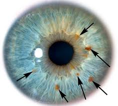 AlpacaAurelius's tweet photo. has anybody else noticed that their eyes have changed colors as theyve gotten healthier? mine have gotten noticeably bluer over time.

your eyes peak volumes about your health. a field called iridology can actually diagnose problems with specific tissues like the gut, liver and lymphatic system based on discolorations in the iris of your eye.

other suggest that heavy metals and inflammation cause a darkening of the eye and detox reverts your eyes to their more natural state.

ive also noticed that when im in a higher dopamine, better mood state, my eyes tend to be much brighter blue.

very fascinating field.