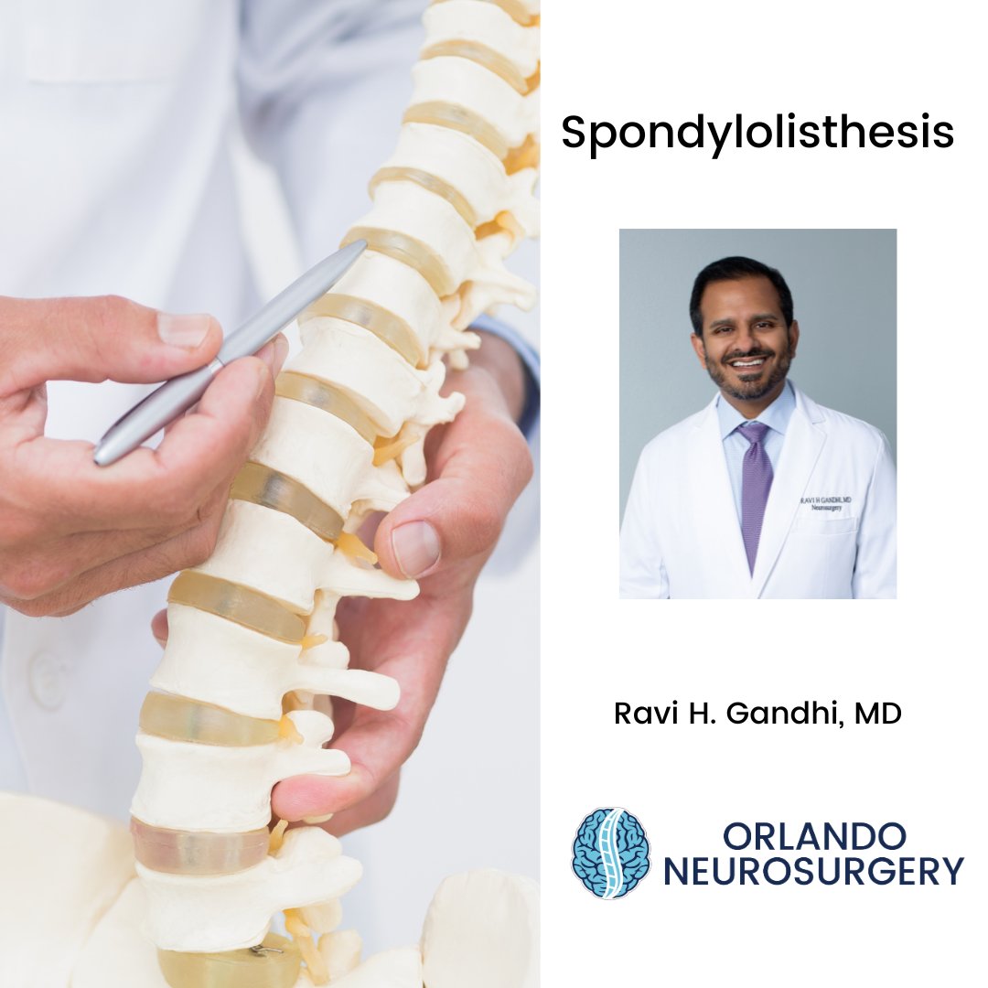 DrRaviHGandhi's tweet image. Spondylolisthesis, a common spinal disorder affecting over 3 million Americans, involves the forward slipping of a vertebra onto the one beneath it. Risk factors include sports stressing the lower back and genetics. #Spondylolisthesis #SpinalDisorder #RaviHGandhiMD