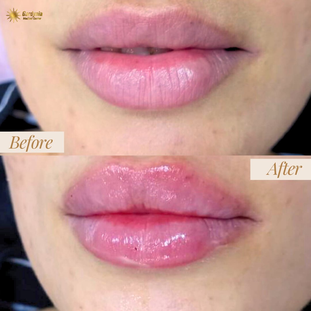 Lips Filler Procedure👄💉✨

#gardyniacenter #gardyniaclinc #lipsfiller #lips #newlips #russianlips #lipsaugmentation #perfectlips #lipsfillerdubai #dubaibeauty #beauty #dubaibeautyclinic #beautyclinic #beautyclinicdubai #beautytips #beautyenhancement #dubailife