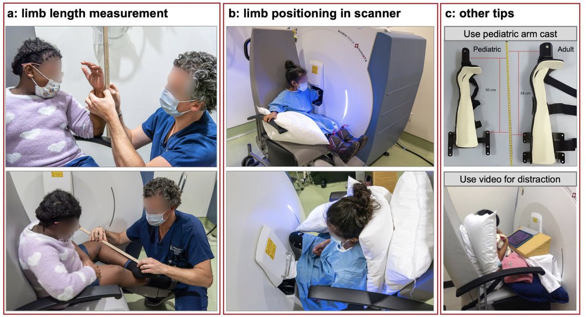 Leigh Gabel, PhD (@leighgabel) on Twitter photo Getting started with high-resolution🦴imaging in kids? Recent collaboration highlighting best practices and recommendations for HR-pQCT. Open access link 👇 rdcu.be/dgxeV <a href="/bwillie8/">Bettina Willie Lab</a> <a href="/aburghardt/">Andrew Burghardt</a> Getting started with high-resolution🦴imaging in kids? Recent collaboration highlighting best practices and recommendations for HR-pQCT. Open access link 👇 rdcu.be/dgxeV <a href="/bwillie8/">Bettina Willie Lab</a> <a href="/aburghardt/">Andrew Burghardt</a>