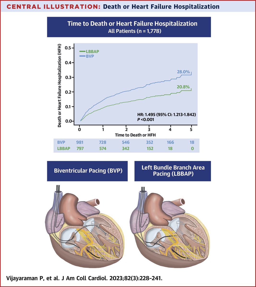 What are the clinical outcomes with biventricular pacing v. left bundle branch area pacing among patients undergoing cardiac resynchronization therapy? Get the answer in #JACC: bit.ly/3rmPzgp