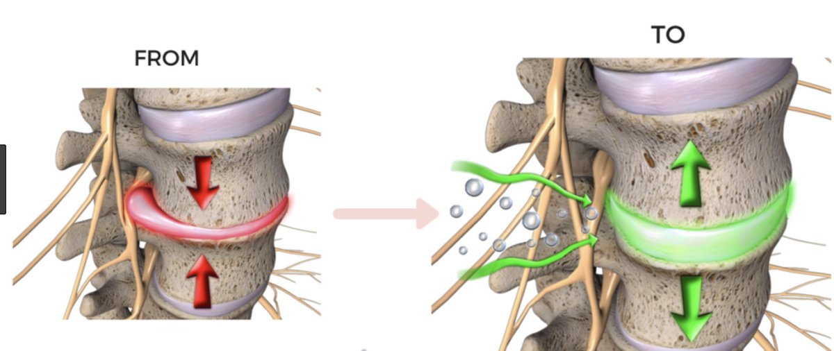 ¿Le gustaría un cupón de $ 49 para un ajuste quiropráctico / evaluación de descompresión espinal / y rayos X si es necesario? Vaya aquí o comente "ESTOY LISTO" gutierrezchiropractic.com/disc