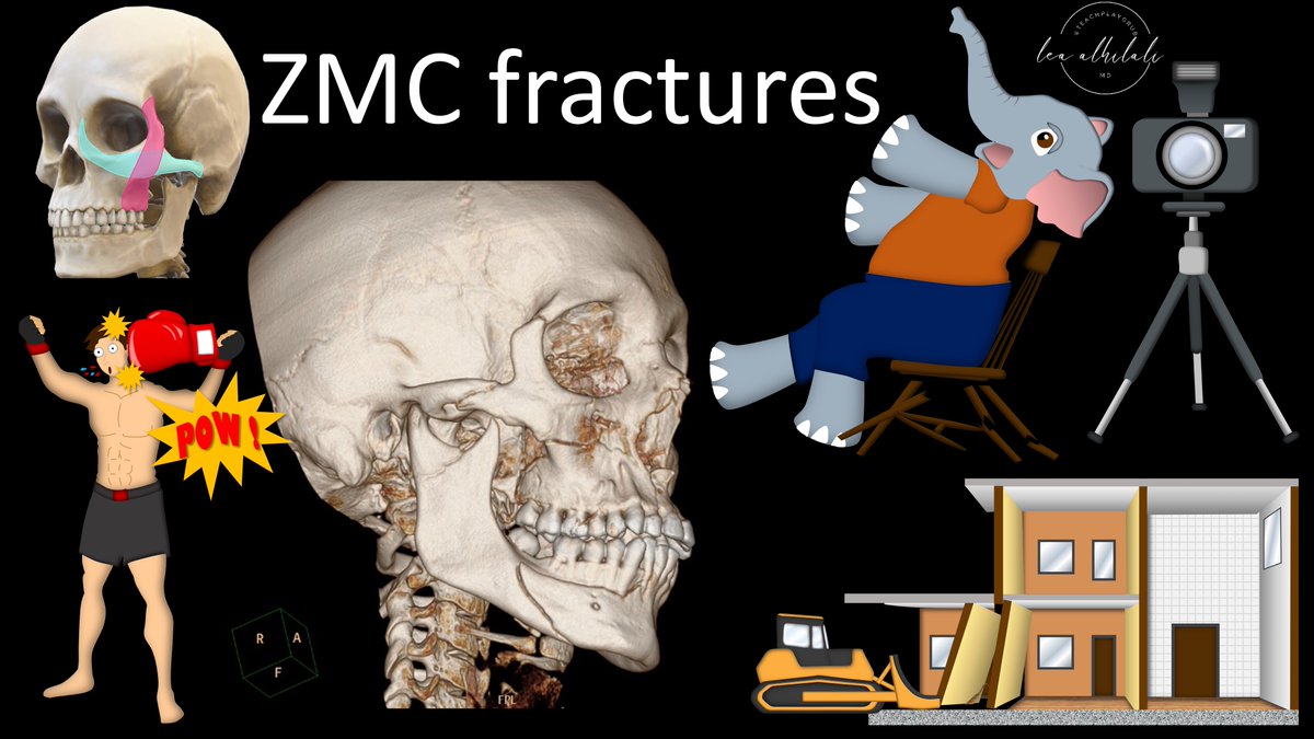 1/Facial fractures get a little cheeky! If you are still calling those lateral facial fractures tri-pods you need to tri-again! Here’s a #tweetorial to help you understand fractures of the zygomaticomaxillary complex or ZMC #medtwitter #meded #FOAMed #radtwitter #radres