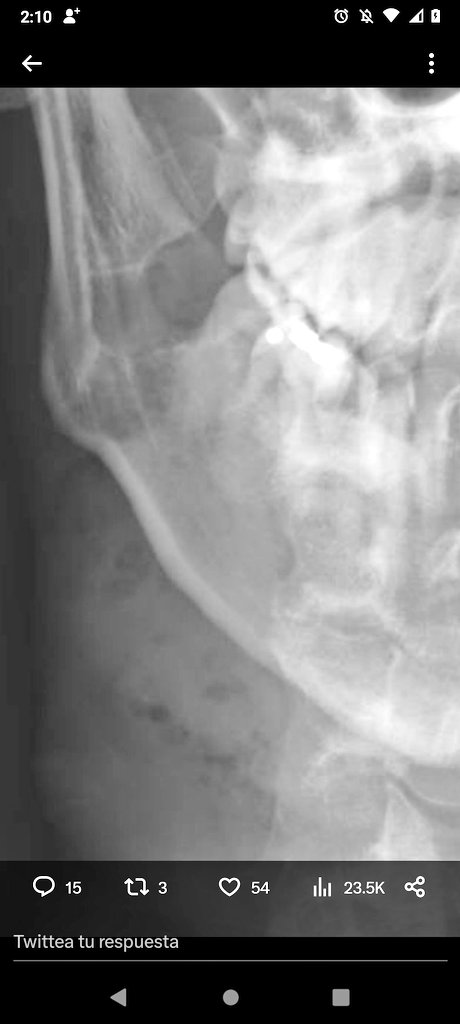 AlejandraCont20's tweet photo. @drjoelsanchez Doctor, este espacio que tiene ahí en el hueso mandibular, es dado por un quiste?, Por una exodoncia mal "cuidada" ? o por qué?... https://t.co/KnU0j7ZsRf