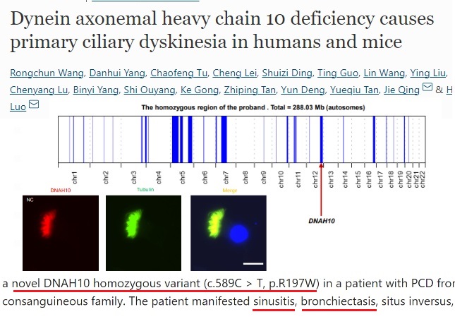 Yoni - יוני (and Rebecca too) (@primary_immune) on Twitter photo "the 1⃣st report of 'DNAH10 deficiency' related to PCD in human and..."
➡️ infection🦠susceptibility,
🫁 bronchiectasis, +
link.springer.com/article/10.100… #pulmonology <a href="/sme_rt/">streamachine retweets 🇬🇧</a> #snrtg #genomics
#raredisease
#immunology "the 1⃣st report of 'DNAH10 deficiency' related to PCD in human and..."
➡️ infection🦠susceptibility,
🫁 bronchiectasis, +
link.springer.com/article/10.100… #pulmonology <a href="/sme_rt/">streamachine retweets 🇬🇧</a> #snrtg #genomics
#raredisease
#immunology
