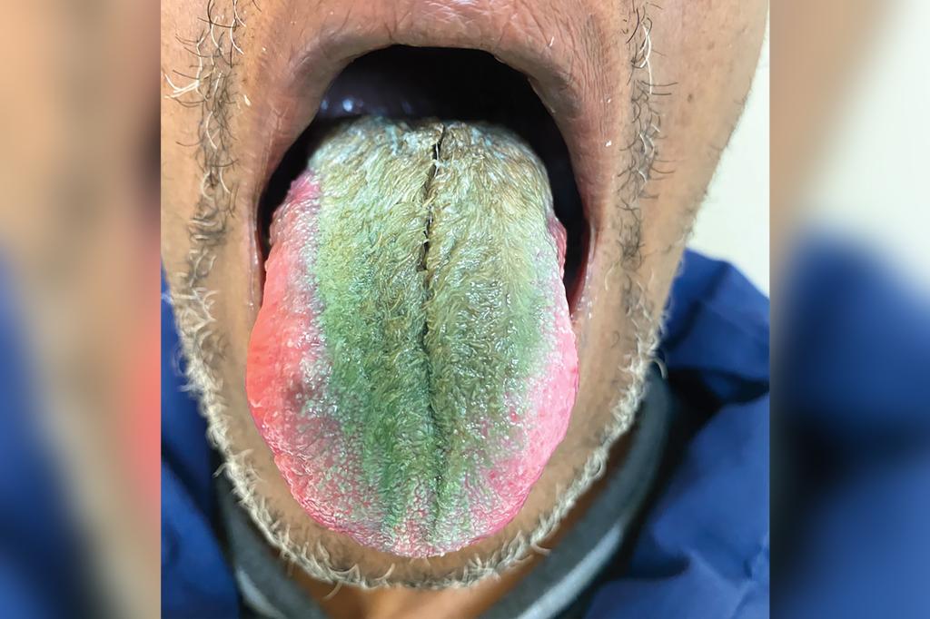 Smoker’s tongue sprouts green hair after years of cigarette use trib.al/V77hKa8
