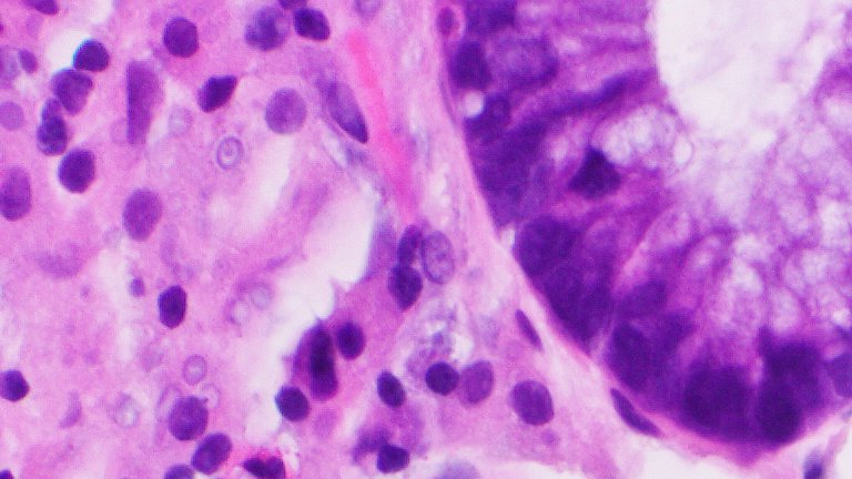 Our editor-in-chief has this treat! What do you guys think? PS A GI biopsy! @bhardwaj_swat <a href="/MLisaZhang/">M. Lisa Zhang, MD</a> <a href="/ALBoothMD/">Adam L. Booth, MD</a> <a href="/RunjanChetty/">Runjan Chetty</a>