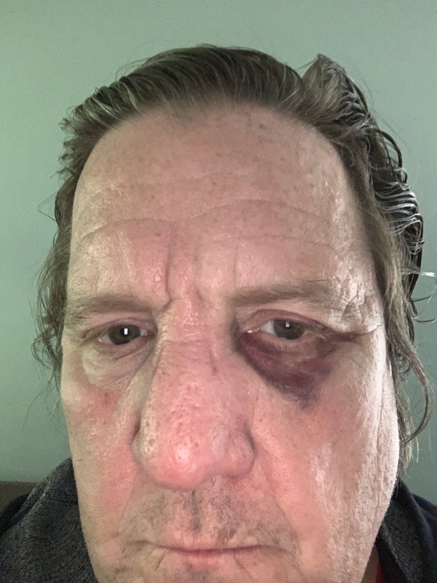 TimKough's tweet image. I was denied an mri I scheduled two months ago. First , because I didn’t bring a paper copy of the order ( my mistake and I proposed running home to get it) Then it was because my insurance didn’t approve it ( they did).  So mri cancelled. My response?  Punch myself in the face.