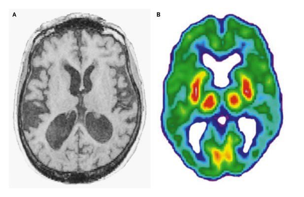 radRounds's tweet photo. Diagnosis in this patient w memory loss? (Source: NEJM) https://t.co/7Mh0G6yUAR