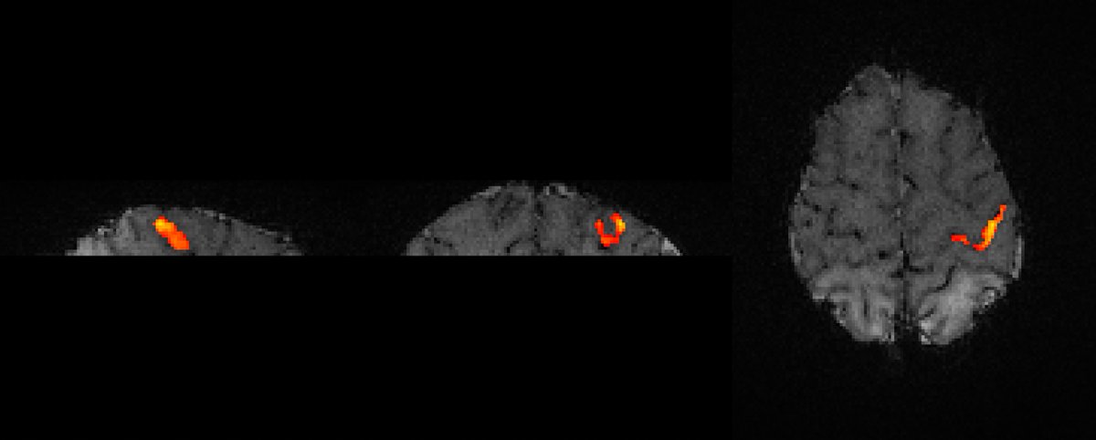 King’s Perinatal Functional Imaging Group (@kings_pfig) on Twitter photo Super excited to share this! Our (<a href="/shaihanmalik/">Shaihan Malik</a> <a href="/JuchaMoore/">Jucha Willers Moore</a>) first (I think the first ever?) ultra-high field task #fMRI from a newborn baby - stunning to see precise spatial localisation of BOLD responses in the developing cortex to right hand movement (at 0.8mm isotropic res) Super excited to share this! Our (<a href="/shaihanmalik/">Shaihan Malik</a> <a href="/JuchaMoore/">Jucha Willers Moore</a>) first (I think the first ever?) ultra-high field task #fMRI from a newborn baby - stunning to see precise spatial localisation of BOLD responses in the developing cortex to right hand movement (at 0.8mm isotropic res)
