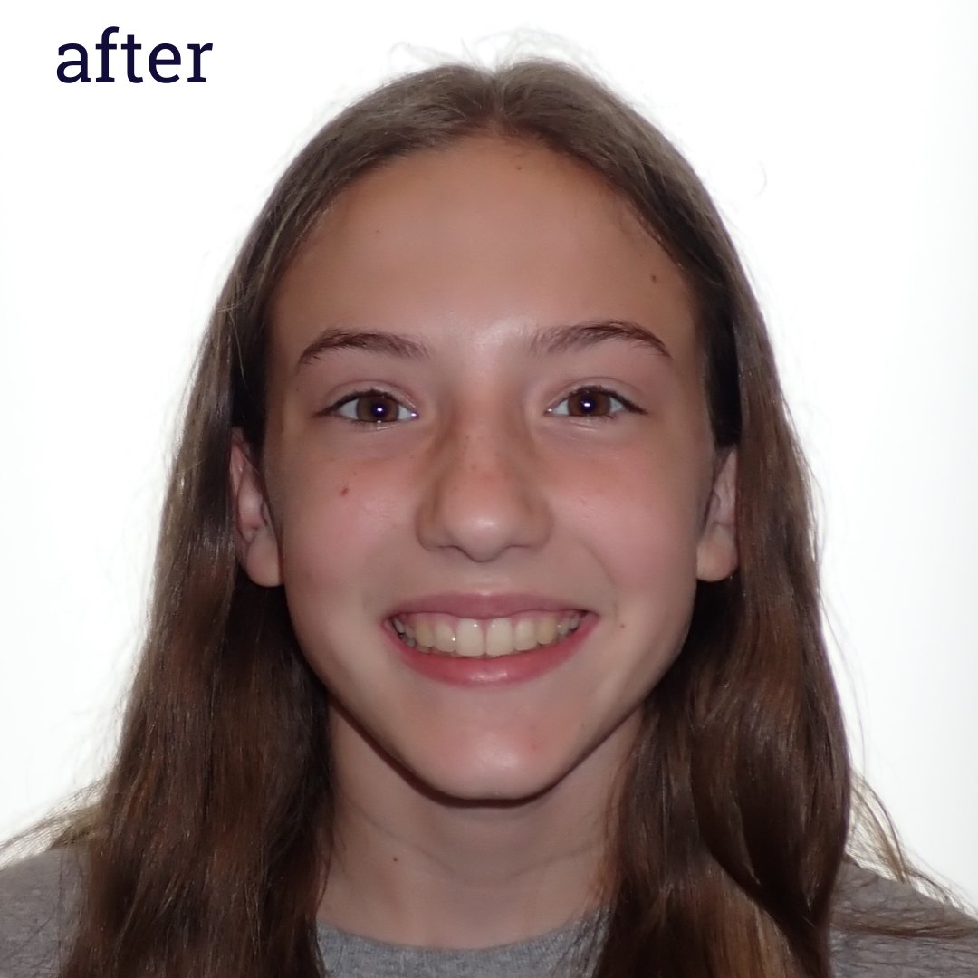 AJSmilesHF's tweet photo. We love transforming your smiles! Check out Maisie's before &amp; after 😁

#ajsmiles #haddonfieldnj #njorthodontist #braces #invisalign #cosmeticorthodontist #ajsmileshf #invisalignsmile https://t.co/CgJcr0tVyH
