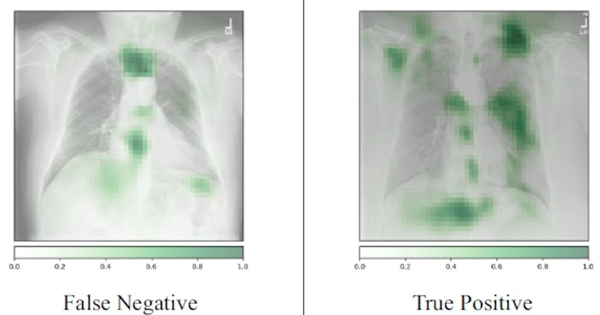AuntMinnie's tweet image. AI algorithm flags potential type II #diabetes cases on chest x-rays #radiology #ImagingAI bit.ly/3NOl0aV