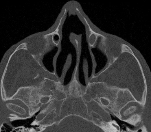 daniel_gewolb's tweet image. Causes of Nasal Septal Perforation

▶️Cocaine use
▶️Prior trauma/surgery
▶️Granulomatosis w/ Polyangiitis
▶️Sarcoidosis
▶️Complication of infection (fungal sinusitis)
▶️Complication of malignancy
▶️Others

#Neurosurgery #ent #radres #futureradres #MedTwitter #NeuroTwitter