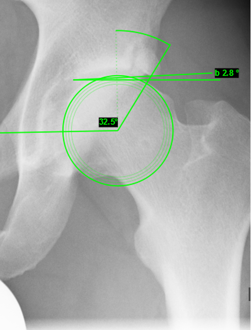 wingletedu's tweet photo. 27y old male patient, professional ice hockey player, presents with localized stress pain in the left groin
How would you handle this case?
#orthotwitter #orthocase #icehockey #hip #patient #sports #medicine #surgery https://t.co/hczLYIaM8u