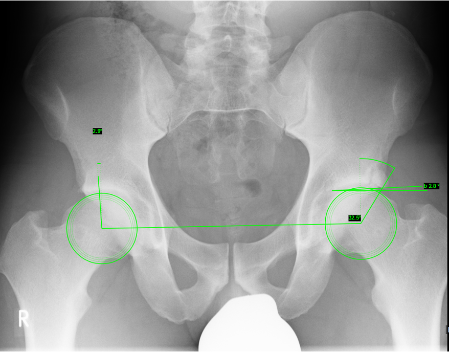 wingletedu's tweet photo. 27y old male patient, professional ice hockey player, presents with localized stress pain in the left groin
How would you handle this case?
#orthotwitter #orthocase #icehockey #hip #patient #sports #medicine #surgery https://t.co/hczLYIaM8u