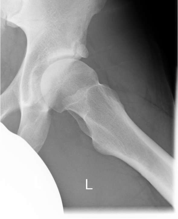 wingletedu's tweet photo. 27y old male patient, professional ice hockey player, presents with localized stress pain in the left groin
How would you handle this case?
#orthotwitter #orthocase #icehockey #hip #patient #sports #medicine #surgery https://t.co/hczLYIaM8u