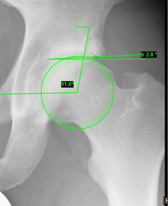 wingletedu's tweet photo. 27y old male patient, professional ice hockey player, presents with localized stress pain in the left groin
How would you handle this case?
#orthotwitter #orthocase #icehockey #hip #patient #sports #medicine #surgery https://t.co/hczLYIaM8u