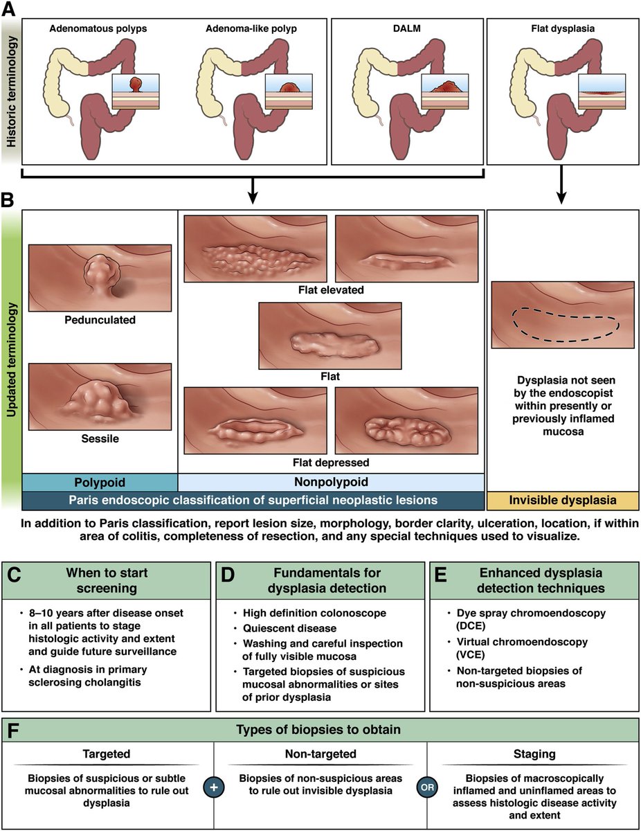 Faiz Ahmad (@gastro_786) on Twitter photo A very useful pictorial from the :"AGA Clinical Practice Update on Endoscopic Surveillance and Management of Colorectal Dysplasia in Inflammatory Bowel Diseases". #GITwitter, #Gastroenterology, #IBD <a href="/AmerGastroAssn/">American Gastroenterological Association (AGA)</a>
Figure :Principles of CRC screening in IBD. A very useful pictorial from the :"AGA Clinical Practice Update on Endoscopic Surveillance and Management of Colorectal Dysplasia in Inflammatory Bowel Diseases". #GITwitter, #Gastroenterology, #IBD <a href="/AmerGastroAssn/">American Gastroenterological Association (AGA)</a>
Figure :Principles of CRC screening in IBD.