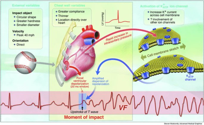 Commotio Cordis in 2023 pubmed.ncbi.nlm.nih.gov/37382827/ #SportsCardiology #commotiocordis #Review #SCD