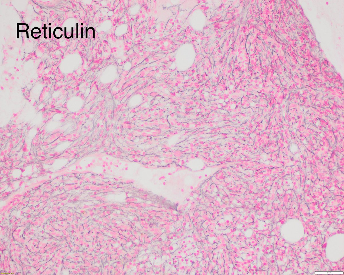 sanamloghavi's tweet photo. New academic year calls for a new  #hemepath pitfall 🧵👇🏻
 
Remember when you see dilated sinusoids in the marrow and a crummy aspirate smear.. it means the marrow is fibrotic.
 1/ #leusm #PathTwitter https://t.co/HVFw4TD0Fe