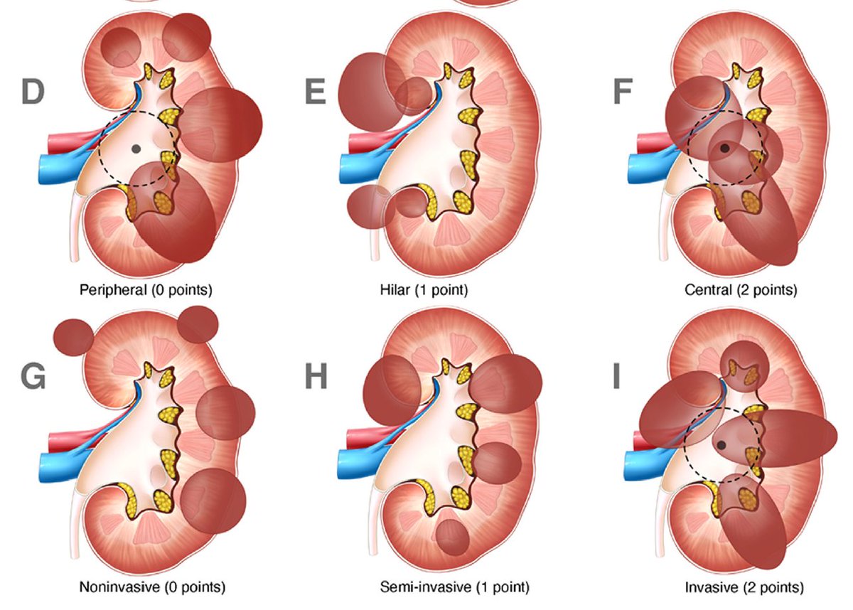 Jeremy Teoh (@jteoh_hk) on Twitter photo Check out this new RPN classification and nephrometry scoring system, specifically designed to assess surgical difficulty of performing robotic partial nephrectomy. Great work by Dr Dinesh Agrawal from the <a href="/TheRMH/">The Royal Melbourne Hospital</a> ! #UroSoMe Check out this new RPN classification and nephrometry scoring system, specifically designed to assess surgical difficulty of performing robotic partial nephrectomy. Great work by Dr Dinesh Agrawal from the <a href="/TheRMH/">The Royal Melbourne Hospital</a> ! #UroSoMe