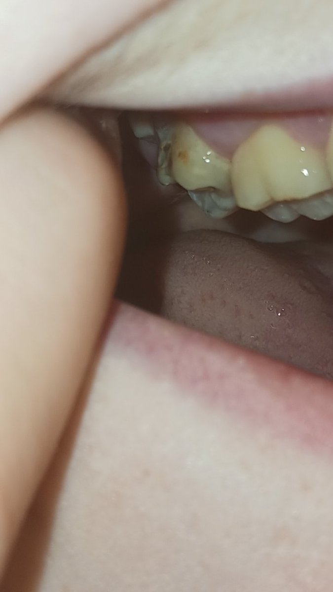 ashmeetsana's tweet photo. fuck fuck fuck... so its actually happening my teeth are fucking rotting https://t.co/EKmX8gmdsz