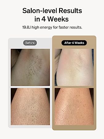 amzn.to/44CkC6c
#LaserHairRemoval