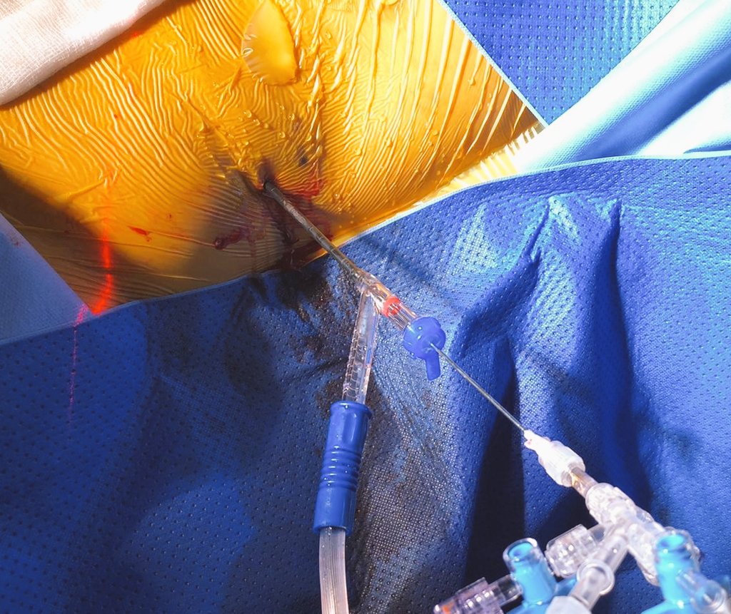 DrG (@docgauhar) on Twitter photo #suction #PCNL #gamechanger
🙏 <a href="/endouro/">Prof Bhaskar Somani</a> <a href="/trwherrmann/">Thomas RW Herrmann</a> <a href="/endourologyucsd/">Manoj Monga</a> <a href="/Urologeman/">Urologeman (Nariman Gadzhiev)</a> <a href="/VirgilioDS/">Virgilio De Stefano</a> <a href="/pmulawkar/">Dr Prashant Mulawkar</a> <a href="/drkemalsarica/">Kemal Sarıca</a> <a href="/ytanidir/">Yiloren Tanidir</a> <a href="/GiacomoPirola/">Giacomo Pirola</a> <a href="/jteoh_hk/">Jeremy Teoh</a> <a href="/D_Castellani/">Daniele Castellani</a> <a href="/eulis_uroweb/">European Section of Urolithiasis - EULIS</a> <a href="/eufocus/">EU Focus</a> <a href="/endouroacademy/">Endourology Academy</a> <a href="/RdonalisioMD/">Dr. Rodrigo Donalisio</a>
<a href="/carlo_giulioni/">Carlo Giulioni</a>
authors.elsevier.com/c/1hO~v8Yy0LQm… #suction #PCNL #gamechanger
🙏 <a href="/endouro/">Prof Bhaskar Somani</a> <a href="/trwherrmann/">Thomas RW Herrmann</a> <a href="/endourologyucsd/">Manoj Monga</a> <a href="/Urologeman/">Urologeman (Nariman Gadzhiev)</a> <a href="/VirgilioDS/">Virgilio De Stefano</a> <a href="/pmulawkar/">Dr Prashant Mulawkar</a> <a href="/drkemalsarica/">Kemal Sarıca</a> <a href="/ytanidir/">Yiloren Tanidir</a> <a href="/GiacomoPirola/">Giacomo Pirola</a> <a href="/jteoh_hk/">Jeremy Teoh</a> <a href="/D_Castellani/">Daniele Castellani</a> <a href="/eulis_uroweb/">European Section of Urolithiasis - EULIS</a> <a href="/eufocus/">EU Focus</a> <a href="/endouroacademy/">Endourology Academy</a> <a href="/RdonalisioMD/">Dr. Rodrigo Donalisio</a>
<a href="/carlo_giulioni/">Carlo Giulioni</a>
authors.elsevier.com/c/1hO~v8Yy0LQm…