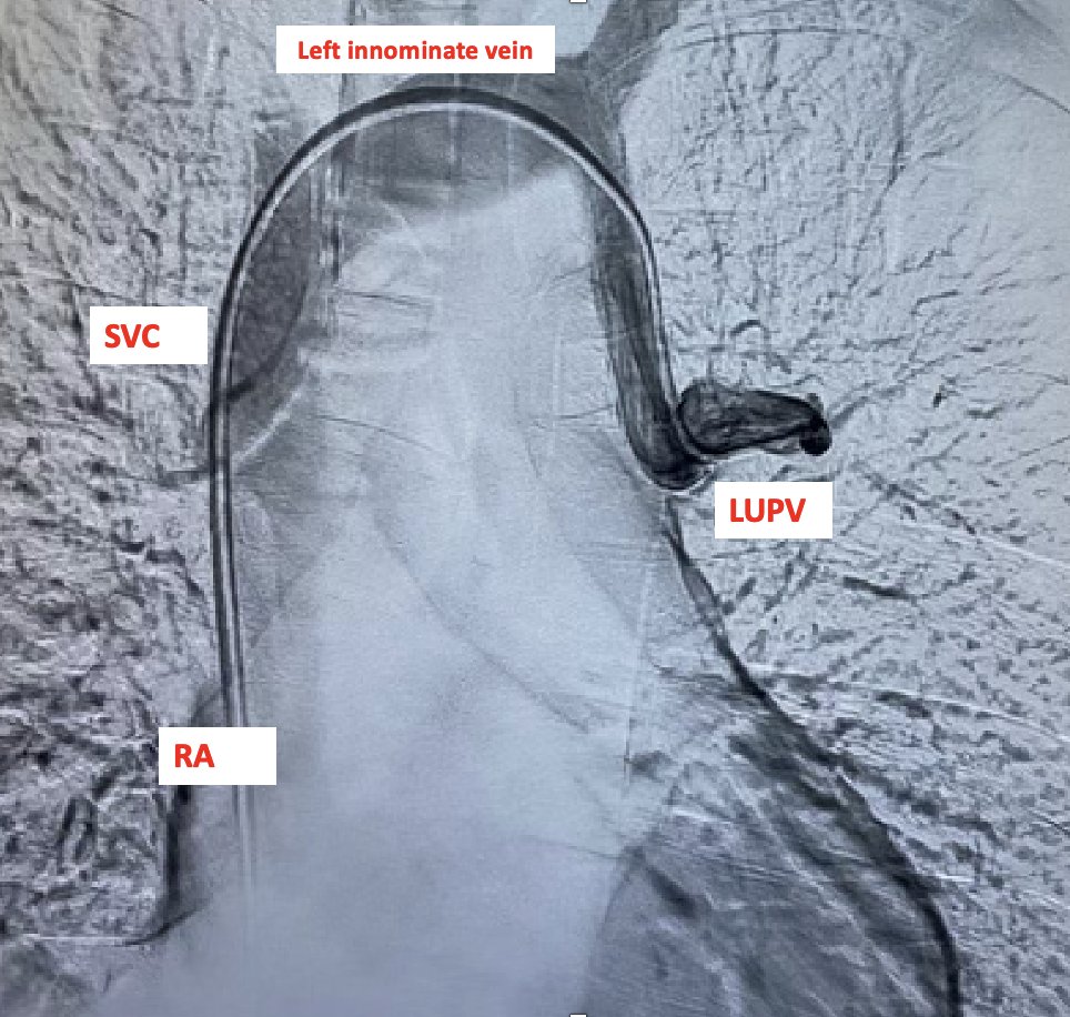 1/ Good teaching hemodynamics case w/ #tweetorial for #ACCFIT #MedTwitter #CardioTwitter

📌Shunt run: 
RA 74%
IVC 70%
but -&gt; SVC 85% !!! 😕

Given high SVC sat, serial sats &amp; venogram helped w/ the diagnosis 👇