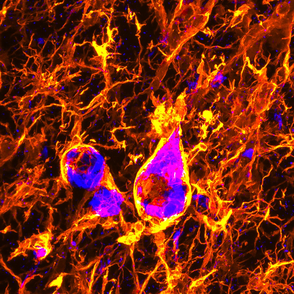 DaniBeckman's tweet photo. Neurons on fire 🔥! Angry microglia (iba1, yellow/red) interacting with neurons containing misfolded tau protein (at8, blue). @zeiss_micro #NeuroTwitter #sciart https://t.co/GlstZrtJVV