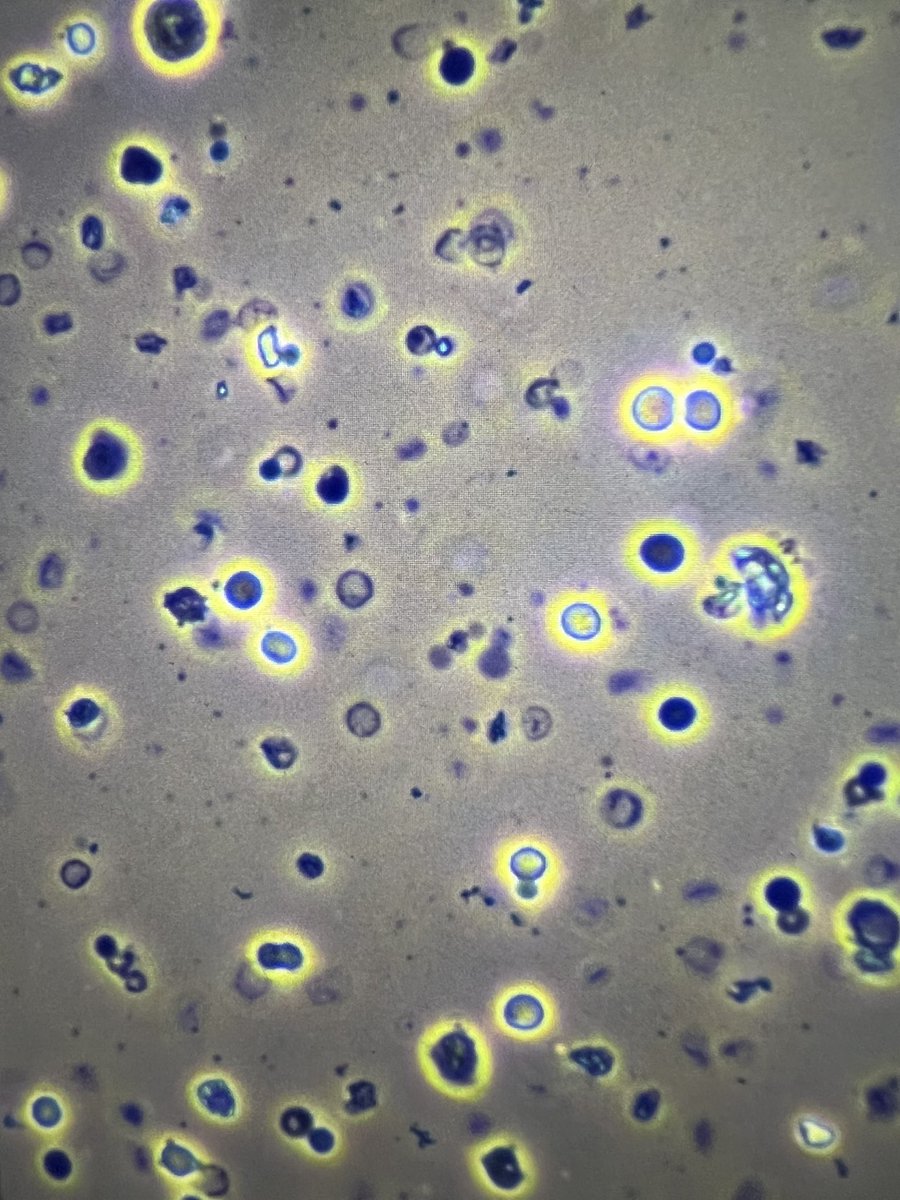 msc271's tweet photo. #Acanthocytes https://t.co/0MKZP8DztA