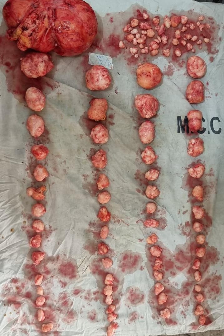 A full day's job: one hundred and four (104) fibroid masses removed from one woman! This beat my previous record of 81 masses from one woman.